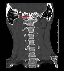 CT MYELOGRAM [CRANIO-CERVICAL]